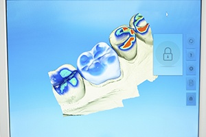 CEREC digital bite impressions