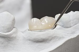Model of tooth with dental crown restoration