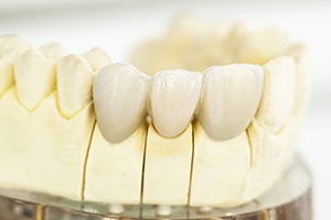 Model of smile with fixed bridge