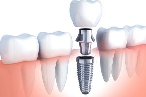 dental implant post, abutment, and crown replacing bottom tooth