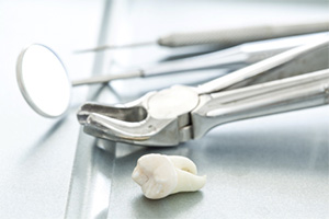 tooth extraction