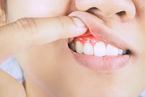 Woman with red, inflamed gums