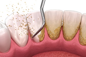 Digital illustration of scaling teeth
