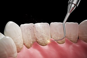 A 3D illustration of a scaling and root planing treatment