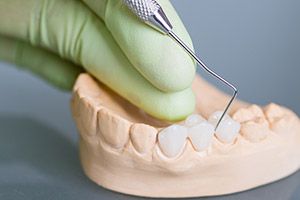 Model of smile with fixed bridge restoration