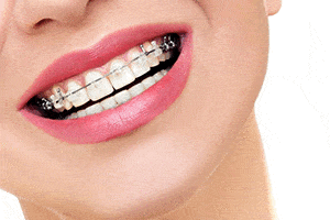 A woman wearing clear metal braces.