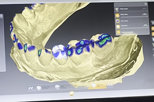 CEREC digital smile design software