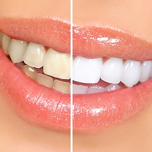 Before and after picture of teeth whitening in Michigan City.