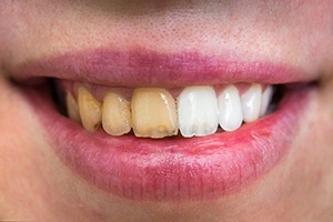 Before and after professional whitening treatment