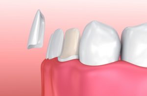 Porcelain Veneers